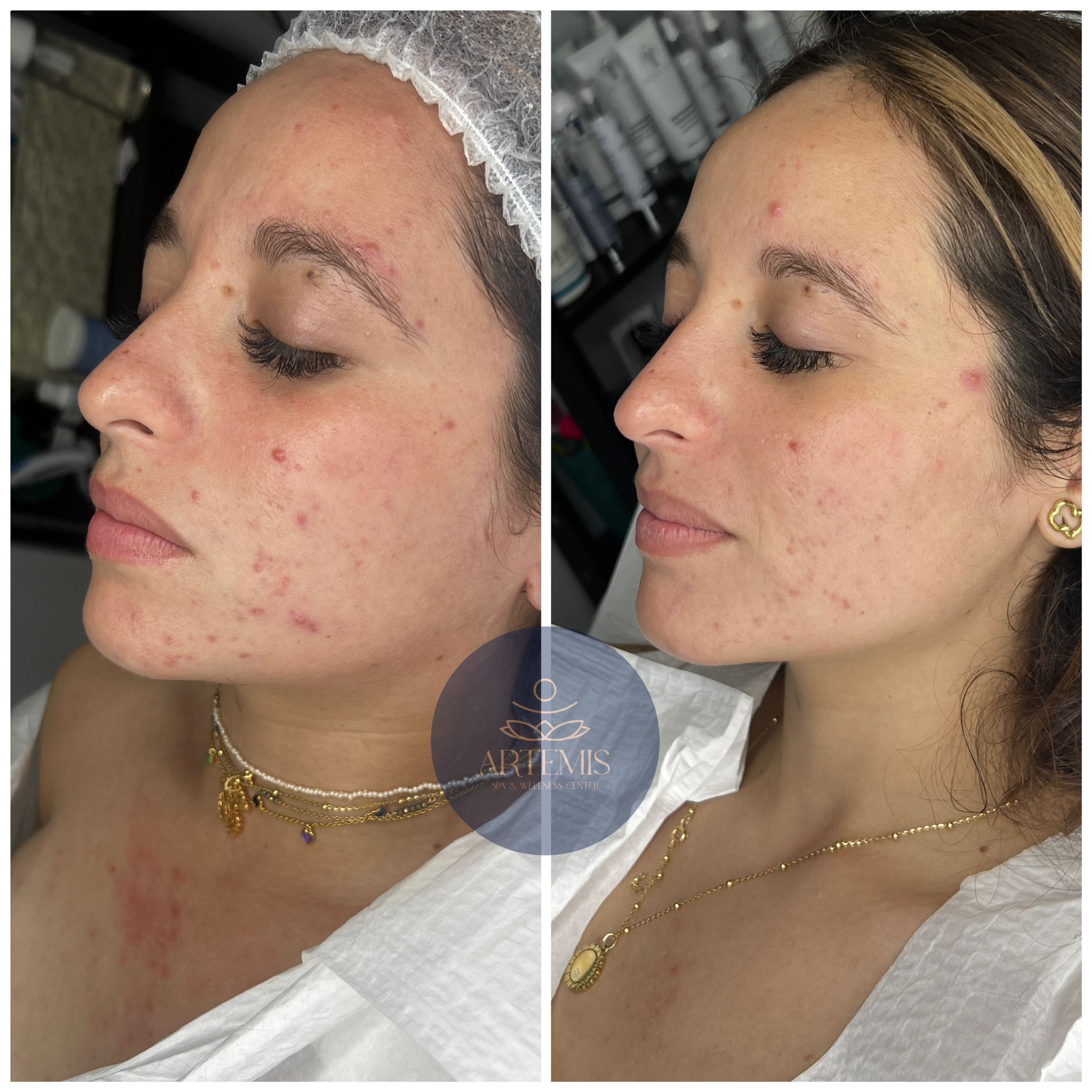 Antes y Después de un Facial de una clienta de lado