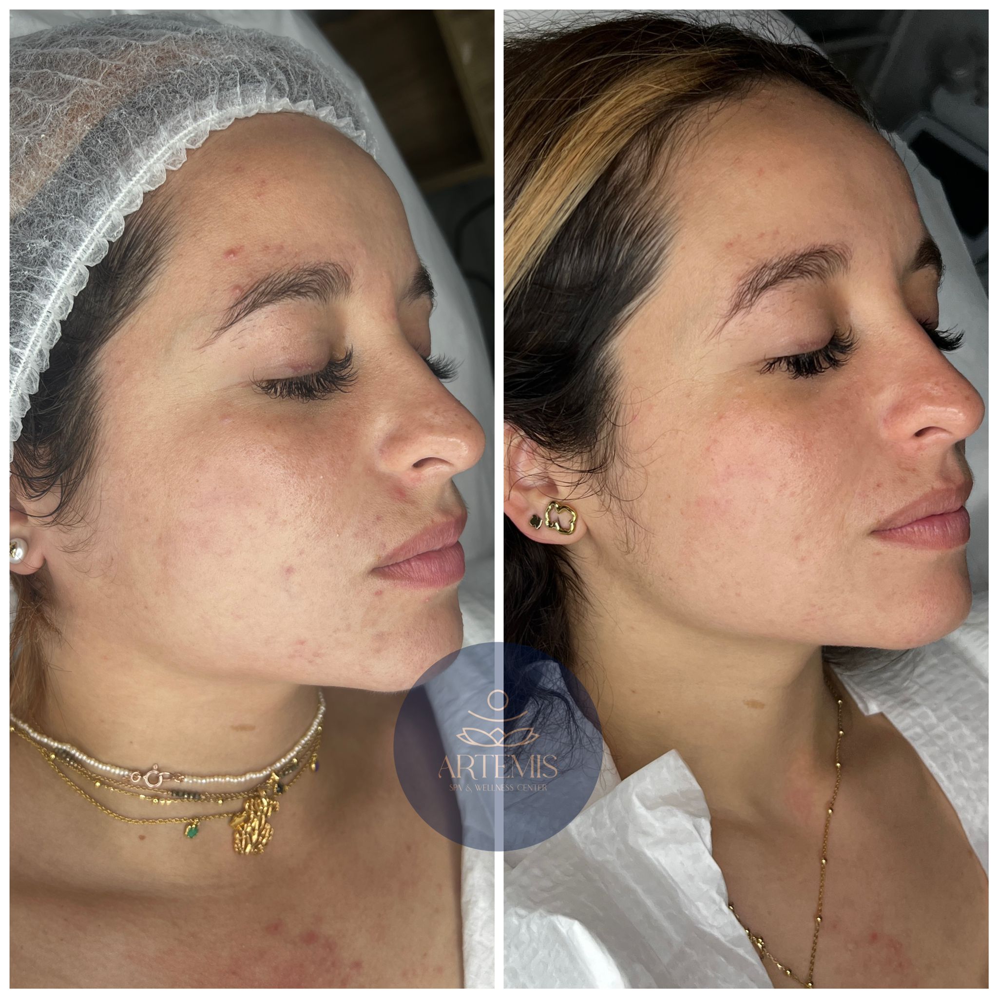 Antes y Después de un Facial de una clienta de lado izquierdo