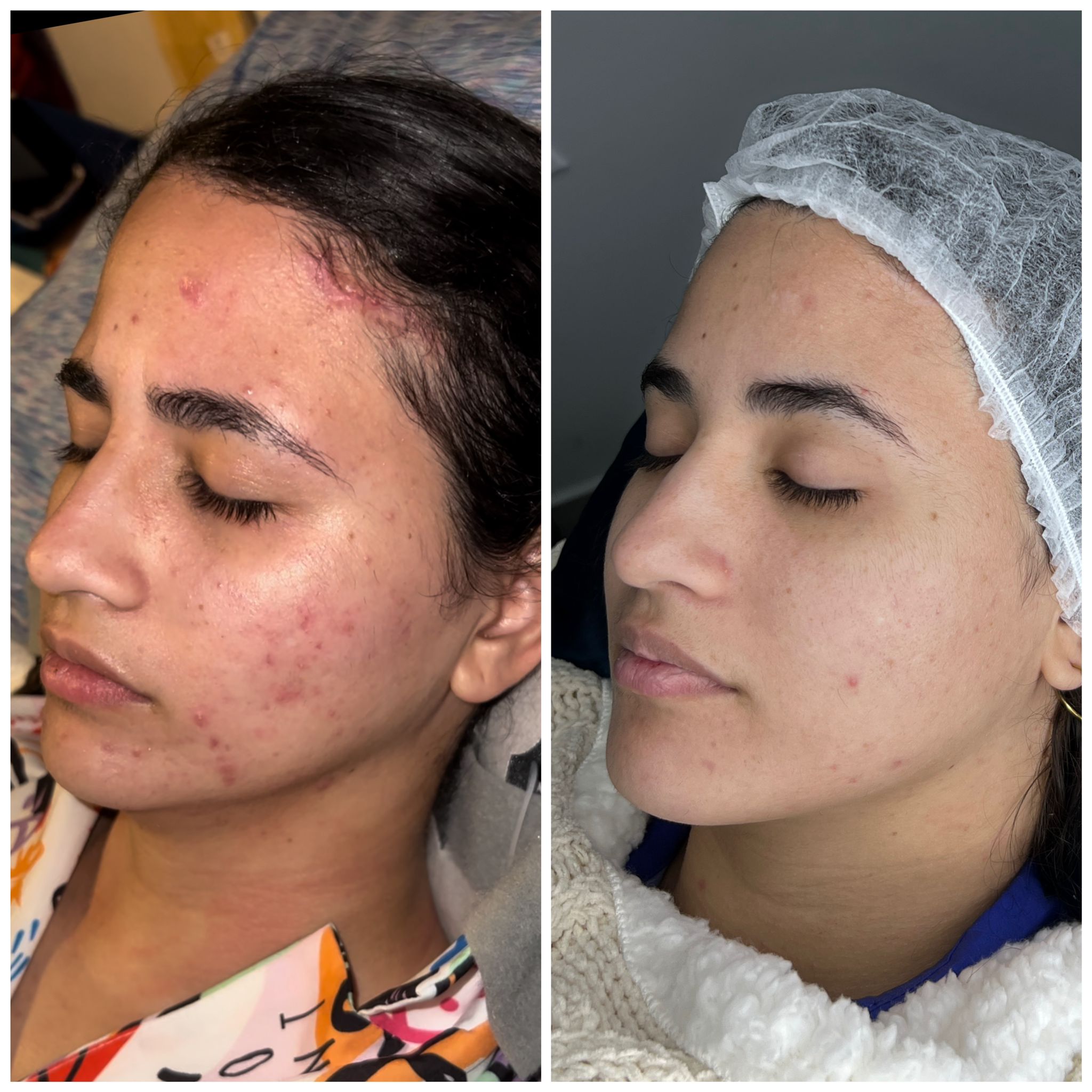 Antes y Después de un Facial de una clienta de lado izquierdo