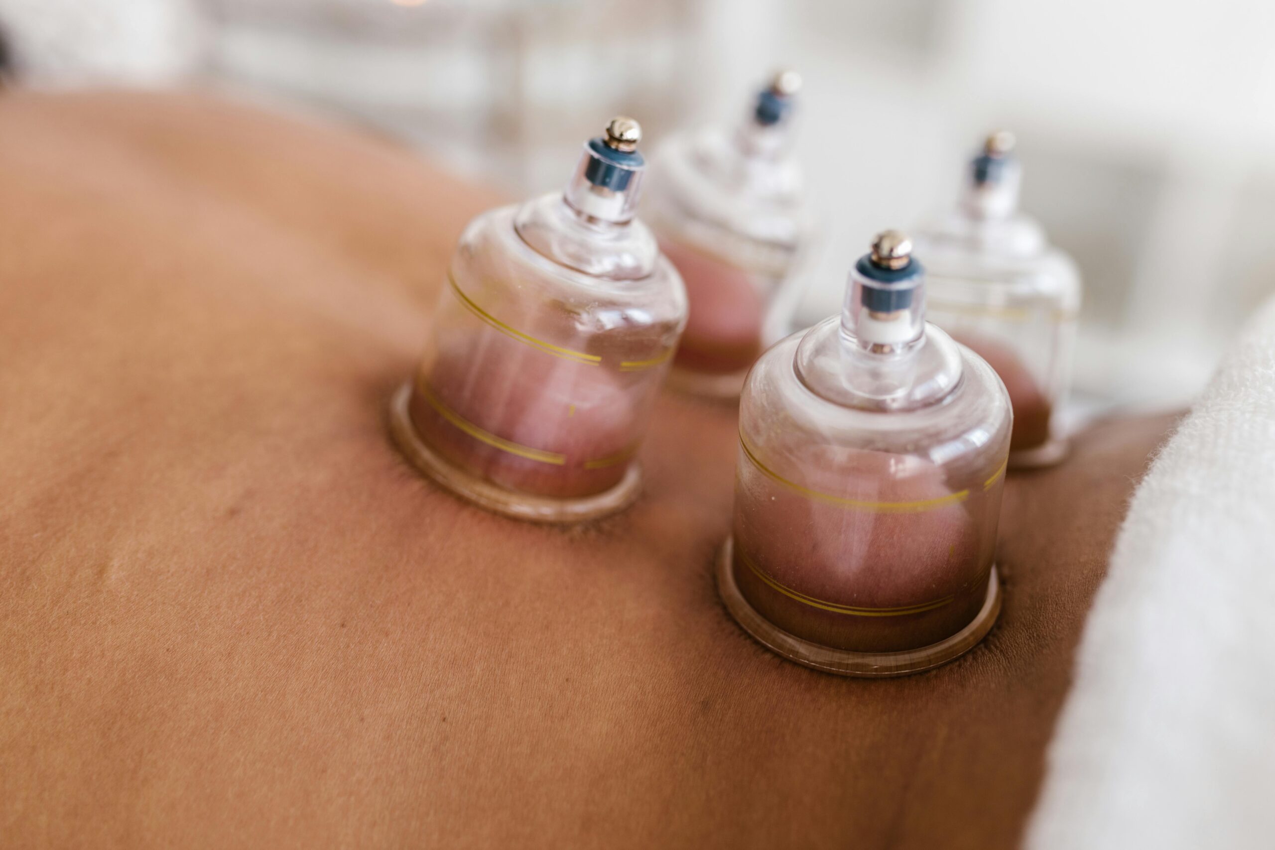 Persona con terapia de cupping en la espalda baja